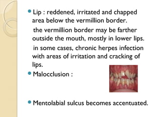 Lip

: reddened, irritated and chapped
area below the vermillion border.
the vermillion border may be farther
outside the mouth, mostly in lower lips.
in some cases, chronic herpes infection
with areas of irritation and cracking of
lips.
Malocclusion :

Mentolabial

sulcus becomes accentuated.

 