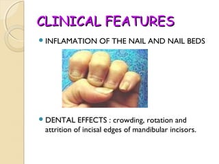 CLINICAL FEATURES
 INFLAMATION

 DENTAL

OF THE NAIL AND NAIL BEDS

EFFECTS : crowding, rotation and
attrition of incisal edges of mandibular incisors.

 