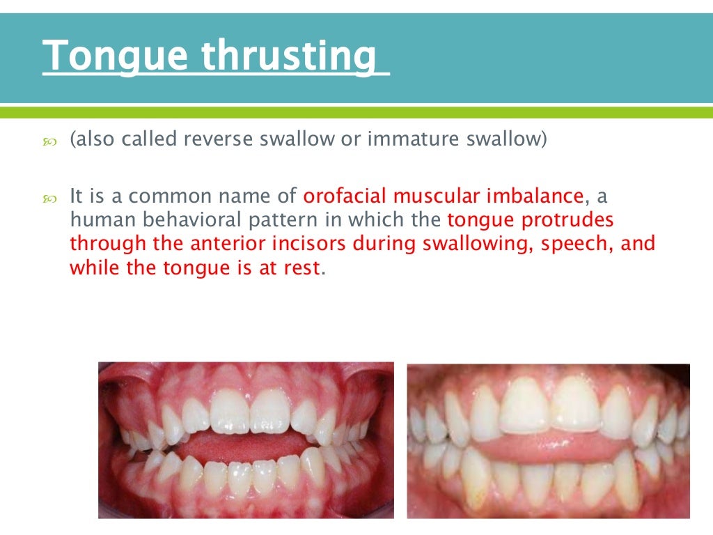 Oral habits & habits breaking appliances + night guard