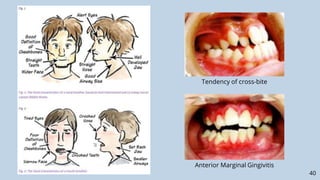 Xbite Tendency Oral Habits Pedo.pptx