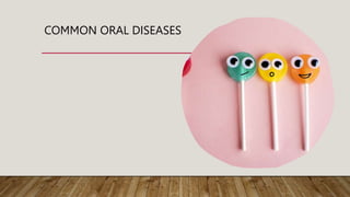 COMMON ORAL DISEASES
 