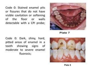 Cpi Probe Color Code Oral health status.pptx