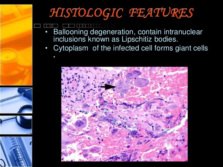 Oral herpes paper presentation