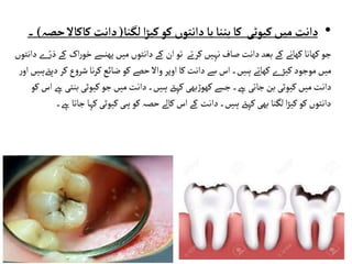 •
‫لگنا‬‫ا‬‫ڑ‬‫کی‬‫کو‬‫دانتوں‬‫یا‬‫بننا‬‫کا‬ ‫کیوٹی‬‫میں‬ ‫دانت‬
(
‫کاک‬ ‫دانت‬
‫حصہ‬‫اال‬
)
‫۔‬
‫دانت‬‫بعد‬‫کے‬ ‫کھانے‬‫کھانا‬‫جو‬
‫خ‬‫پھنسے‬‫میں‬‫دانتوں‬‫کے‬ ‫ان‬‫تو‬ ‫کرتے‬‫نہیں‬ ‫صاف‬
‫کے‬ ‫اک‬‫ر‬‫و‬
‫دانتوں‬‫ے‬ّ‫ر‬‫ذ‬
‫ہیں‬ ‫کھاتے‬ ‫ے‬‫کیڑ‬ ‫موجود‬‫میں‬
‫اس‬‫۔‬
‫سے‬
‫اوپر‬‫کا‬‫دانت‬
‫ضائع‬ ‫کو‬‫حصے‬ ‫واال‬
‫ک‬ ‫ع‬‫و‬‫شر‬‫نا‬‫ر‬‫ک‬
‫ر‬
‫دیےتہیں‬
‫ر‬‫او‬
‫جسے‬‫ےہ۔‬‫جاتی‬‫بن‬ ‫کیوٹی‬‫میں‬‫دانت‬
‫بھی‬‫ڑ‬‫کھو‬
‫ب‬‫کیوٹی‬‫جو‬‫میں‬‫دانت‬‫ہیں۔‬ ‫کہےت‬
‫ےہ‬‫نتی‬
‫اس‬
‫کو‬
‫ج‬ ‫کہا‬‫کیوٹی‬‫ہی‬‫کو‬‫حصہ‬ ‫کالے‬‫اس‬‫کے‬ ‫دانت‬‫ہیں۔‬ ‫کہےت‬‫بھی‬ ‫لگنا‬‫ا‬‫ڑ‬‫کی‬‫کو‬‫دانتوں‬
‫ےہ۔‬‫اتا‬
 