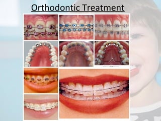 Orthodontic Treatment

 