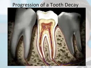 Progression of a Tooth Decay

 