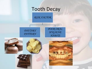 Tooth Decay

 