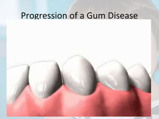 Progression of a Gum Disease

 