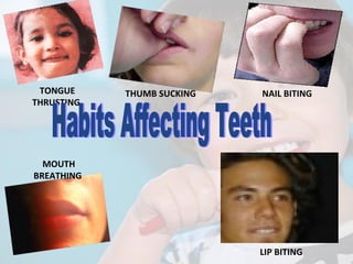TONGUE
THRUSTING

THUMB SUCKING

NAIL BITING

MOUTH
BREATHING

LIP BITING

 