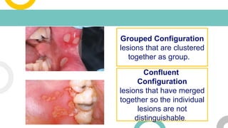 Oral lesions Description and Types .pptx