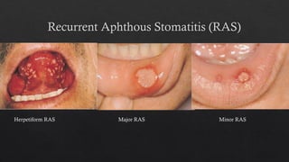Minor Ras Ulcers Comprehensive Guide to Oral Lesions for Oral Hygienists: Identification ...
