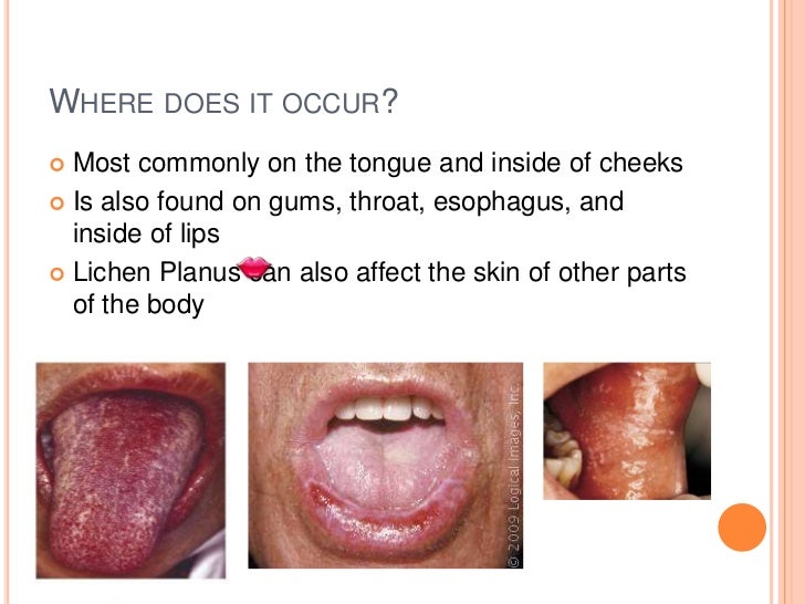 Oral lichen planus