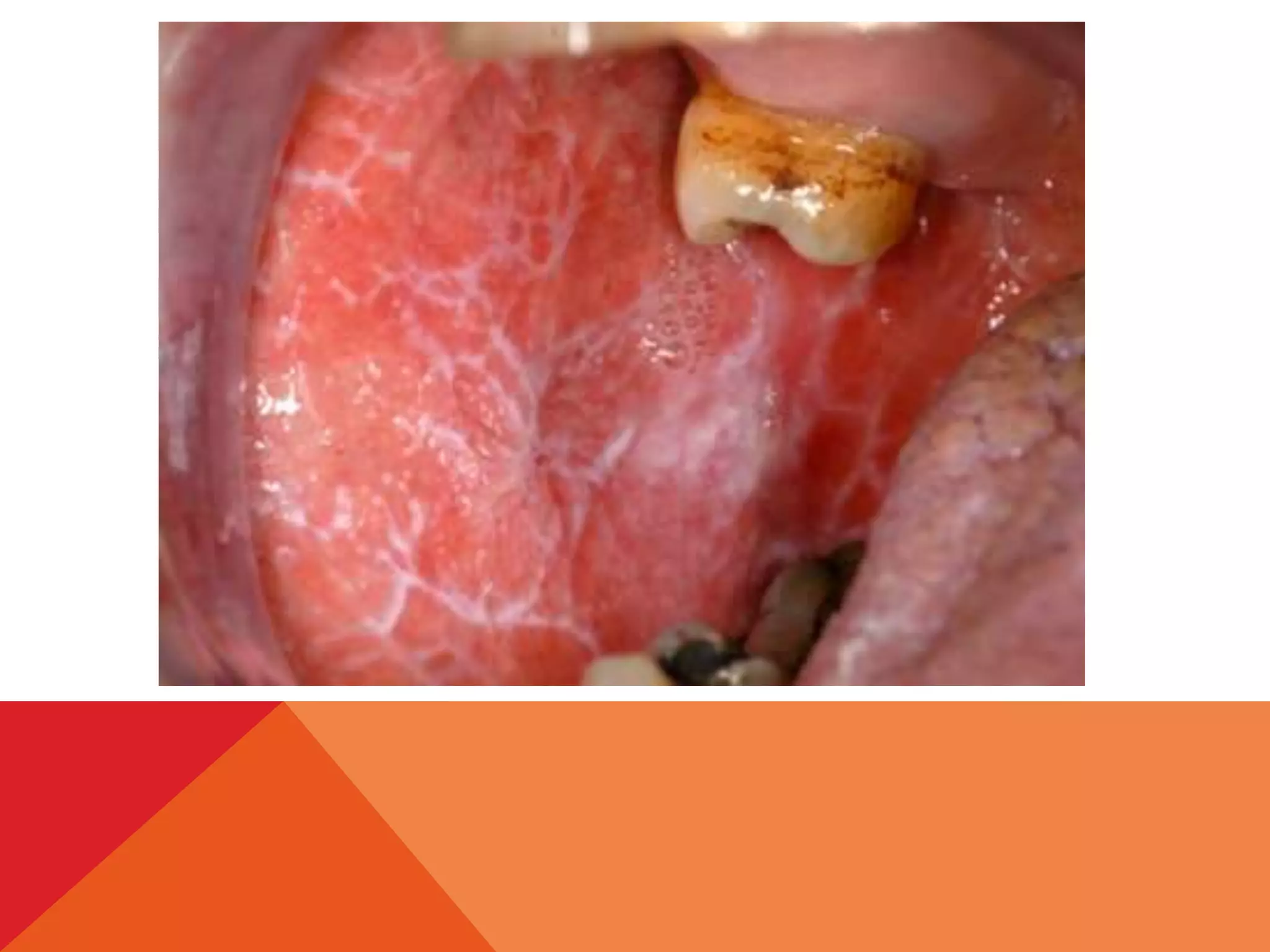 Oral lichen planus | PPTX