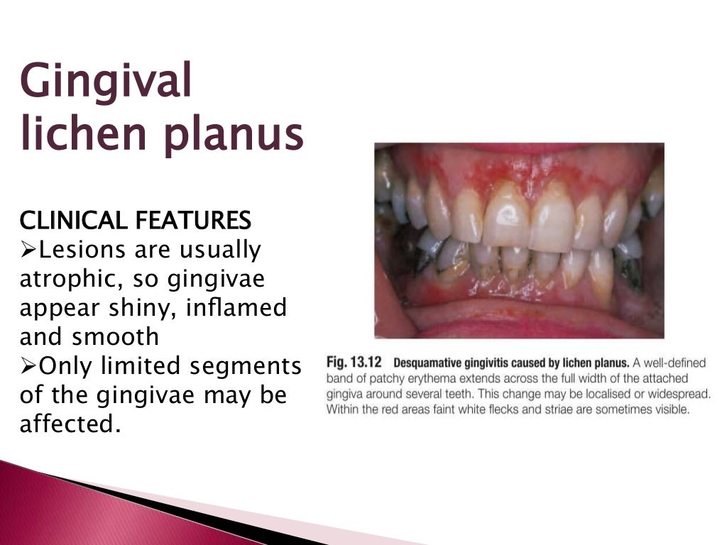 Oral lichen planus