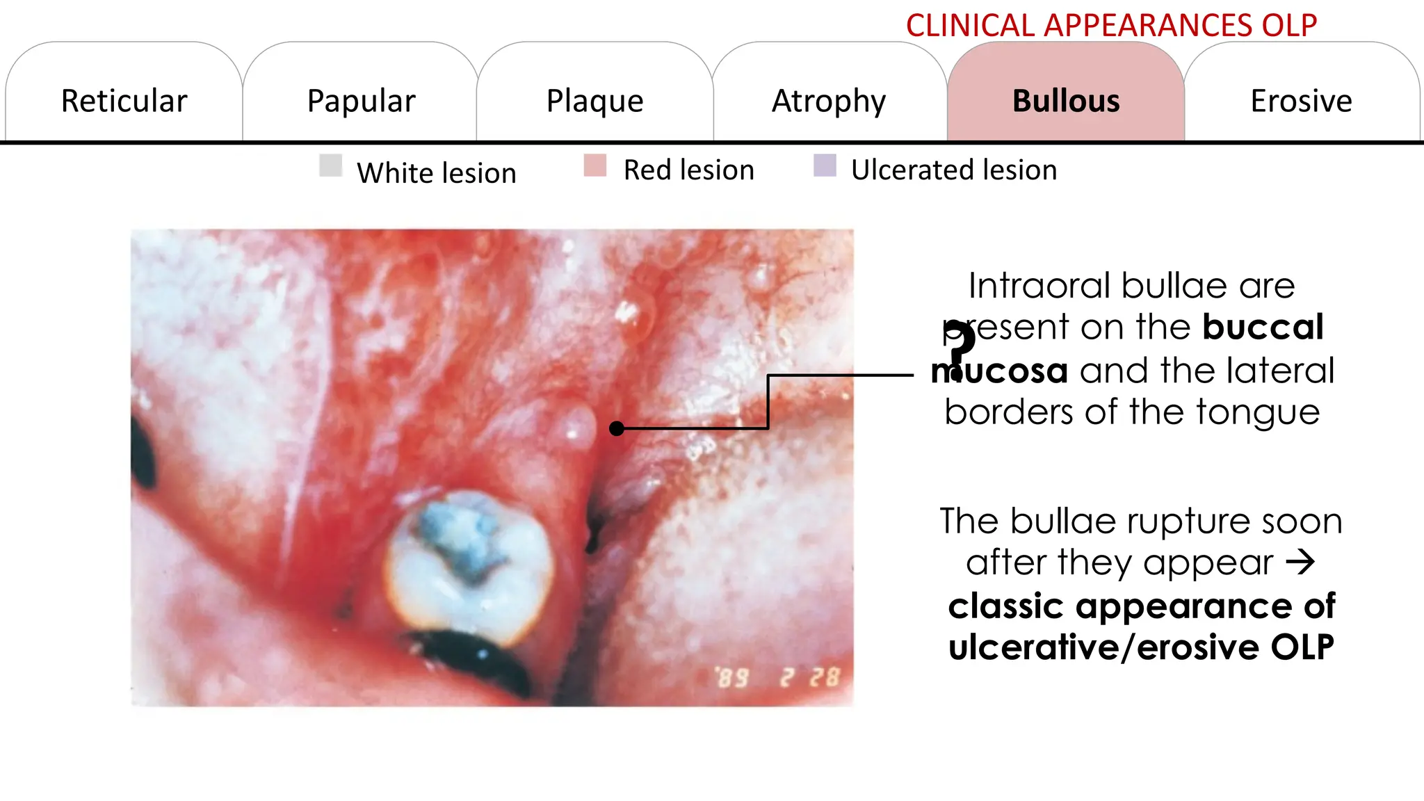 Oral Lichen Planus PDF Oral Lichen Planus PDF