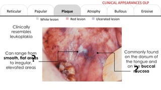 Reticular Papular Atrophy Erosive
Bullous
Plaque
White lesion Red lesion Ulcerated lesion
Clinically
resembles
leukoplakia
Can range from
smooth, flat areas
to irregular,
elevated areas
Commonly found
on the dorsum of
the tongue and
on the buccal
mucosa
CLINICAL APPEARANCES OLP
?
?
 