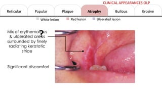 Reticular Papular Atrophy Erosive
Bullous
Plaque
White lesion Red lesion Ulcerated lesion
Mix of erythematous
& ulcerated areas
surrounded by finely
radiating keratotic
striae
Significant discomfort
CLINICAL APPEARANCES OLP
?
 