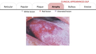 Reticular Papular Atrophy Erosive
Bullous
Plaque
White lesion Red lesion Ulcerated lesion
CLINICAL APPEARANCES OLP
 