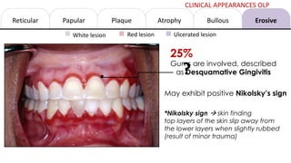 Reticular Papular Atrophy Erosive
Bullous
Plaque
White lesion Red lesion Ulcerated lesion
Gums are involved, described
as Desquamative Gingivitis
*Nikolsky sign à skin finding
top layers of the skin slip away from
the lower layers when slightly rubbed
(result of minor trauma)
May exhibit positive Nikolsky’s sign
25%
CLINICAL APPEARANCES OLP
?
 