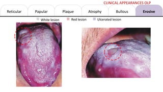 Reticular Papular Atrophy Erosive
Bullous
Plaque
White lesion Red lesion Ulcerated lesion
CLINICAL APPEARANCES OLP
 