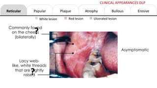 Reticular Papular Atrophy Erosive
Bullous
Plaque
White lesion Red lesion Ulcerated lesion
Commonly found
on the cheeks
(bilaterally)
Lacy web-
like, white threads
that are slightly
raised
Asymptomatic
?
?
CLINICAL APPEARANCES OLP
 