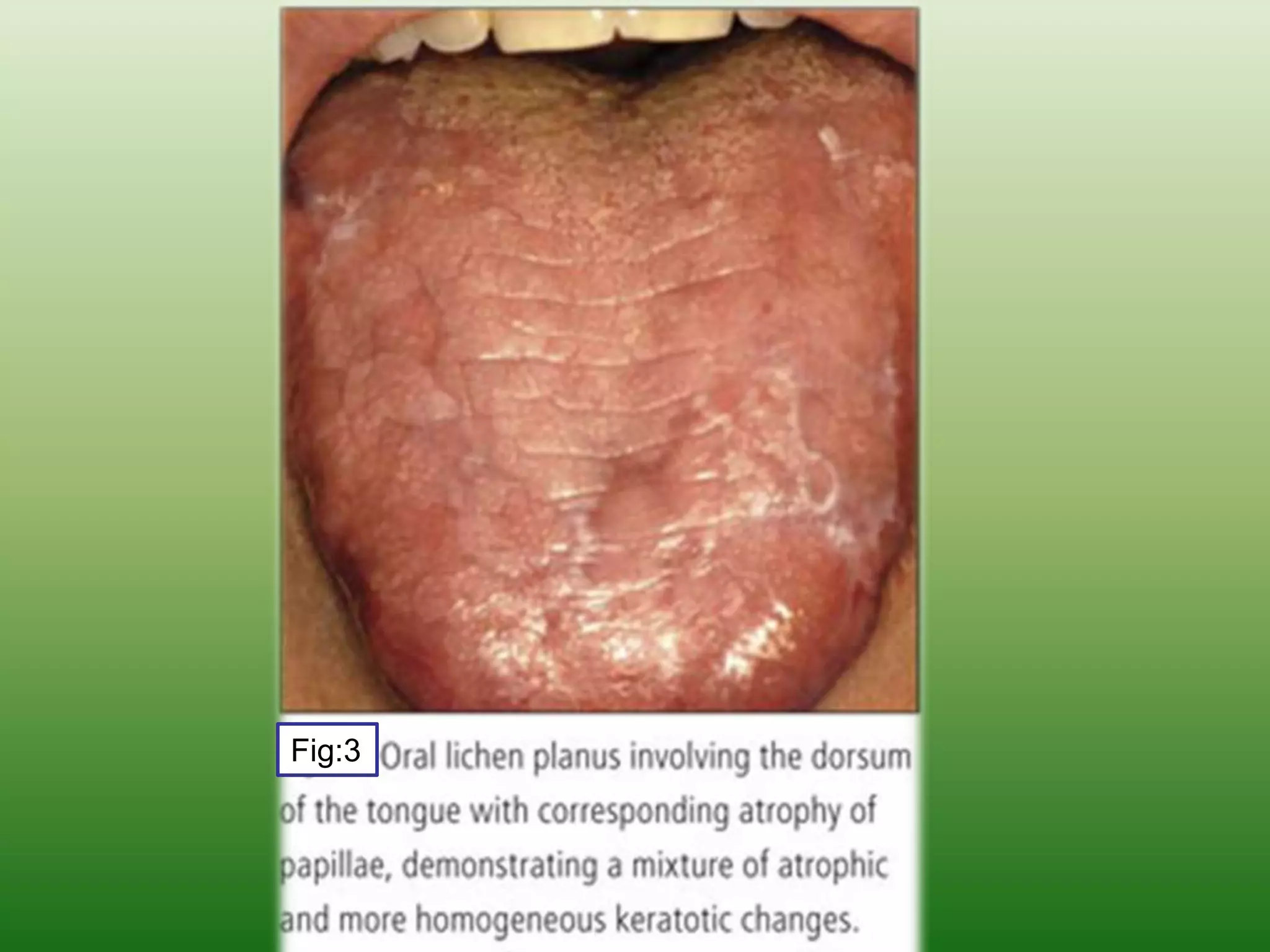 Oral Lichen Planus OLP PPTX