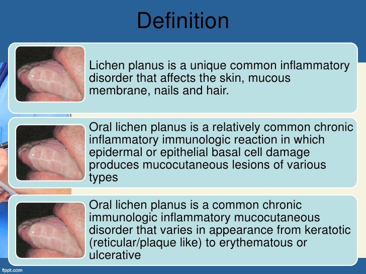 Oral Lichen Planus (OLP)