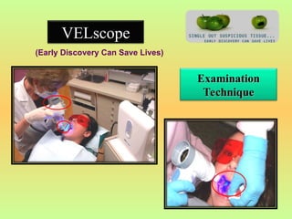 Oral Lumenoscopy An Adjuvant in Early Screening of Oral Cancer.ppt