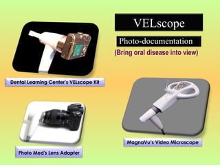 Velscope Kit Oral Lumenoscopy An Adjuvant in Early Screening of Oral Cancer.ppt