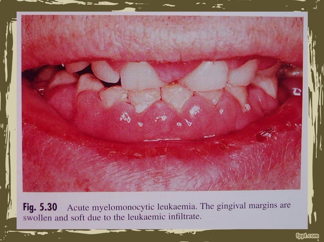 Oral manifestation of leukemia | PPT - Oral Stomatitis Leukemia Online Community