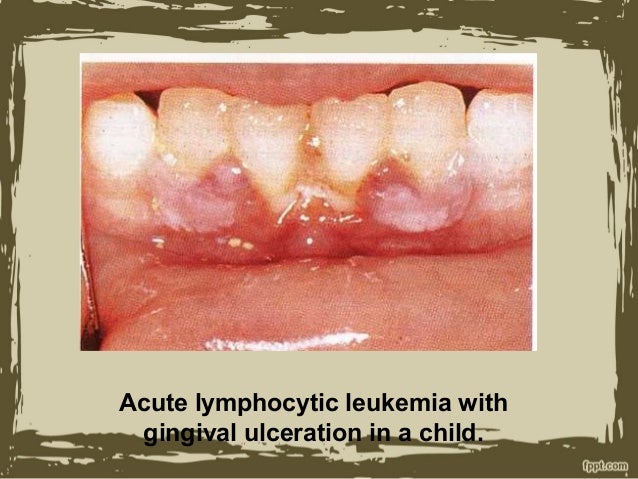 Oral manifestation of leukemia