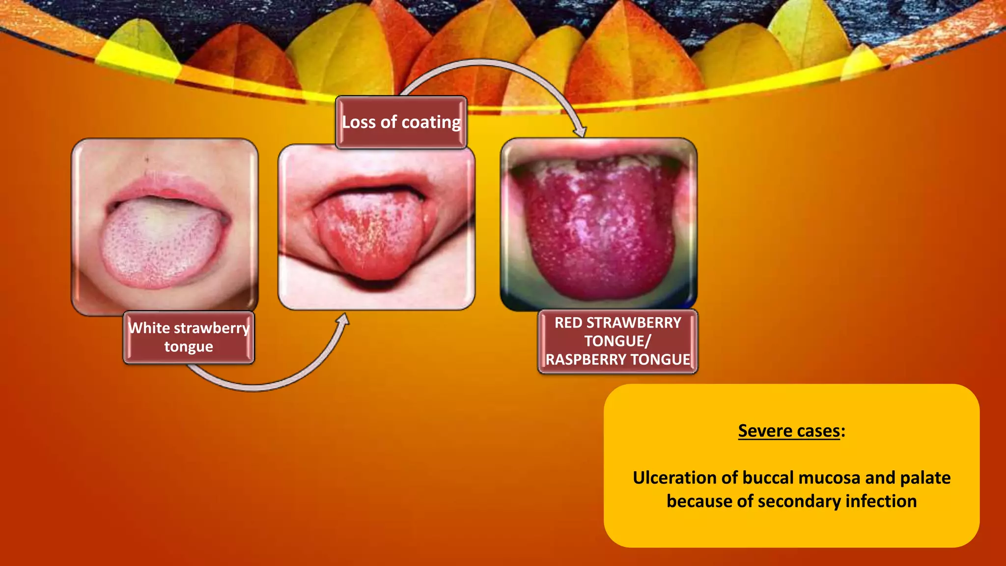 Oral manifestations of bacterial infections | PPTX