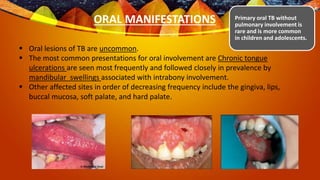 Oral manifestations of bacterial infections | PPTX