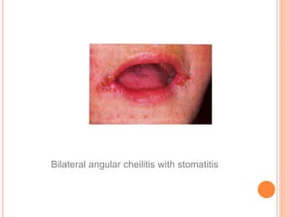 Oral manifestations of blood disorders | PPTX
