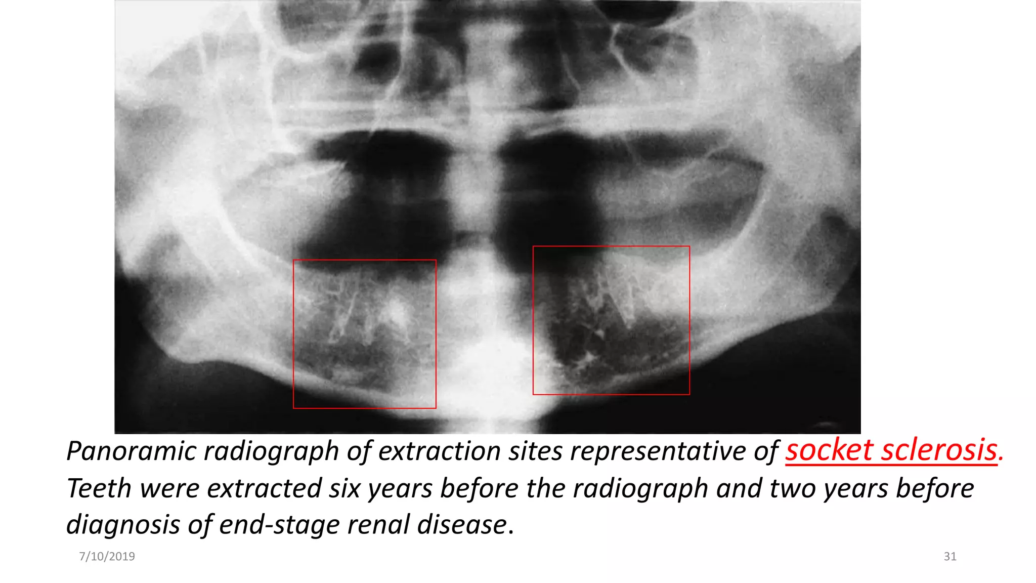 Extracted Socket Radiograph Oral manifestations of renal diseases | PPTX