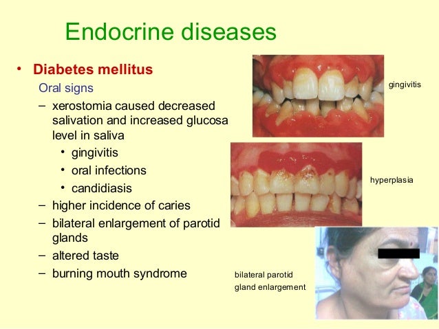 problems with mouth diabetes systemic Oral diseases of manifestations