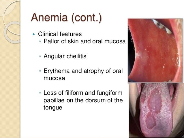 Oral manifestations of systemic diseases