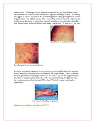 appear within a 72-hour period and begin on the extremities (see the following image). 
Lesions remain in a fixed location for at least 7 days and then begin to heal. Lesions may 
also appear as arcuate lesions (see the second image below). Precipitating factors include 
herpes simplex virus (HSV), Epstein-Barr virus (EBV), and histoplasmosis. Because this 
condition may be related to a persistent antigenic stimulus, recurrence is the rule rather 
than the exception, with most affected individuals experiencing 1-2 recurrences per year. 
Target lesion of erythema multiforme 
. 
Raised atypical targets and arcuate lesions. 
Erythema multiforme major and Stevens-Johnson syndrome (SJS), however, are more 
severe, potentially life-threatening disorders (see the image below). Lesions of Steven- 
Johnson syndrome typically begin on the face and trunk. They are flat, atypical lesions, 
described as irregular purpuric macules with occasional blistering. Most patients also 
have extensive mucosal involvement. More than 50% of all cases are attributed to 
medications. 
Note extensive sloughing of epidermis. 
Erythema multiforme vs SJS and TENS 
 