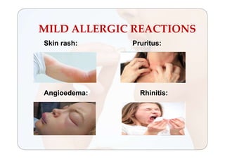 MILD ALLERGIC REACTIONS
Skin rash: Pruritus:
Angioedema: Rhinitis:
 