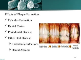 106
Effects of Plaque Formation
 Calculus Formation
 Dental Caries
 Periodontal Disease
 Other Oral Disease
 Endodontic Infections
 Dental Abscess
 