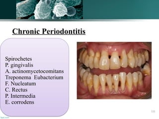 Chronic Periodontitis
Spirochetes
P. gingivalis
A. actinomycetocomitans
Treponema Eubacterium
F. Nucleatum
C. Rectus
P. Intermedia
E. corrodens
131
 