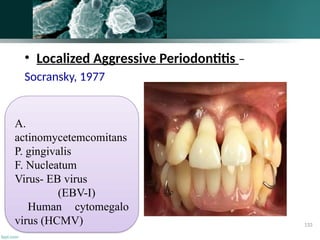 • Localized Aggressive Periodontitis –
Socransky, 1977
A.
actinomycetemcomitans
P. gingivalis
F. Nucleatum
Virus- EB virus
(EBV-I)
Human cytomegalo
virus (HCMV) 133
 