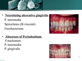 • Necrotizing ulcerative gingivitis
P. intermedia
Spirochetes (B.vincenti)
Fusobacterium
• Abscesses of Periodontium
F.nucleatum
P. intermedia
P. gingivalis
134
 