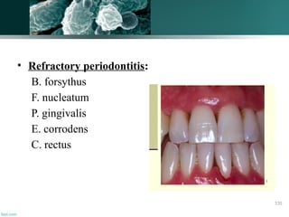 • Refractory periodontitis:
B. forsythus
F. nucleatum
P. gingivalis
E. corrodens
C. rectus
135
 