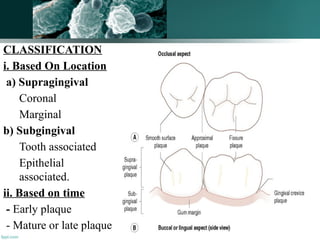 83
CLASSIFICATION
i. Based On Location
a) Supragingival
Coronal
Marginal
b) Subgingival
Tooth associated
Epithelial
associated.
ii. Based on time
- Early plaque
- Mature or late plaque
 