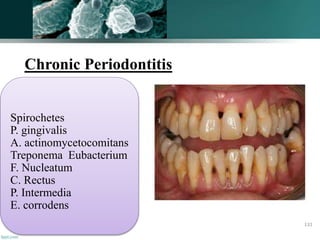 Chronic Periodontitis
Spirochetes
P. gingivalis
A. actinomycetocomitans
Treponema Eubacterium
F. Nucleatum
C. Rectus
P. Intermedia
E. corrodens
131
 