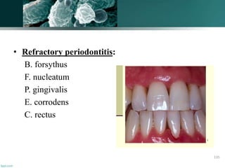 • Refractory periodontitis:
B. forsythus
F. nucleatum
P. gingivalis
E. corrodens
C. rectus
135
 