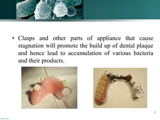 • Clasps and other parts of appliance that cause
stagnation will promote the build up of dental plaque
and hence lead to accumulation of various bacteria
and their products.
29
 