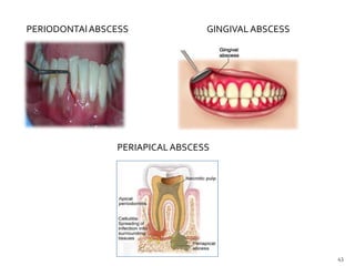 PERIODONTAlABSCESS GINGIVALABSCESS
PERIAPICALABSCESS
43
 