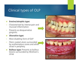 Clinical types of OLP
 Erosive/atrophic type:
 Characterised by intense pain and
mucosal inflammation
 Presents as desquamative
gingivitis
 Ulcerative type:
 Most disabling form of OLP
 Fibrin coated ulcers surrounded
by erythematous zones and white
striae in periphery
 Bullous type: Presents as bullous
lesions surrounded by Wickham’s
striae
 